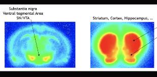 Spect Vector Simultaneous SPECT imaging of neurotransmitter systems in the brain ...