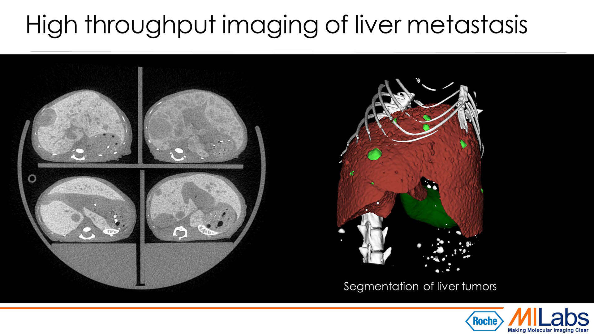 rendered preclinical imaging of liver metastasis