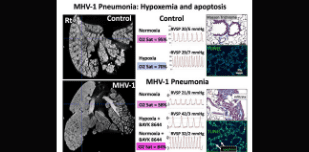 Imaging SARS-CoV-2 attacks mitochondria in cardiopulmonary cells in COVID-19 pneumonia
